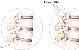 a bulging disc vs a normal disc