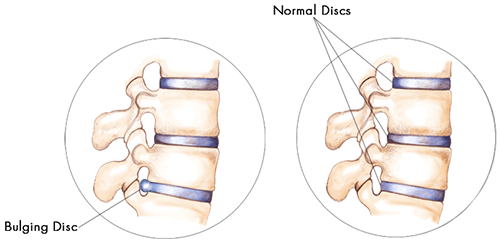 What Causes a Bulging Disc?