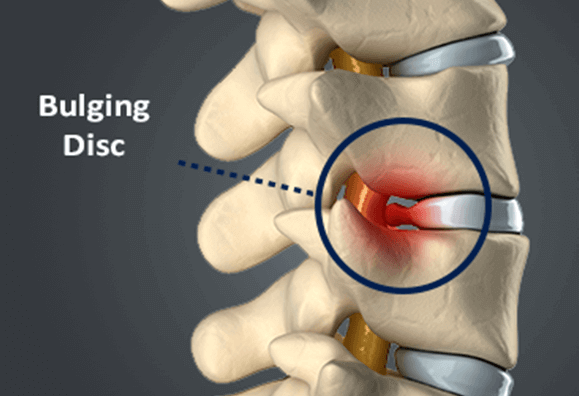 Tips For Lumbar Herniated Disc Pain Relief, Back Pain