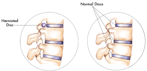 Herniated disc of the thoracic spine