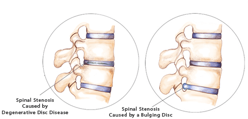 Spinal Stenosis Causes  Inherited vs. Acquired
