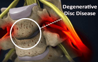 degenerative disc disease diagram