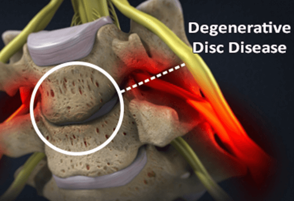 Pillow of Degenerative disc disease, 3D CT scan