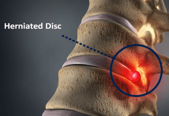 Bulging disk in back: What is it, pictures, symptoms, and treatment