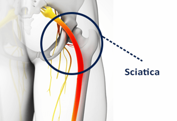 Taming the pain of sciatica: For most people, time heals and less is more -  Harvard Health