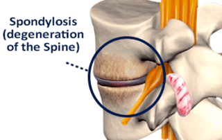 spondylosis (degeneration of the spine)