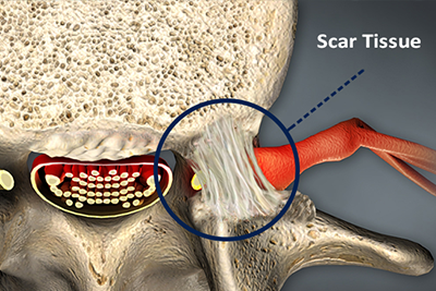 Scar Tissue Removal Surgery - Scar Removal
