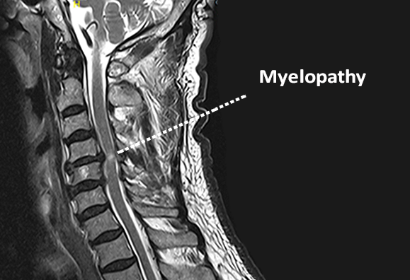 can cervical myelopathy cause death