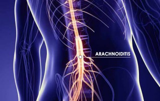 arachnoiditis