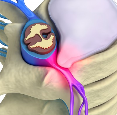 What Age Is the Most at Risk for a Herniated Disc?