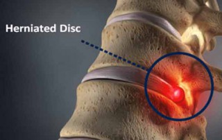 intervertebral herniated disc