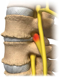 Bilateral Foraminal Stenosis Causes Symptoms Treatment Bonati