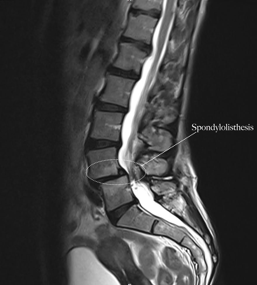 spondylolisthesis radiology